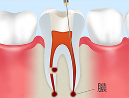 すでに神経がなくても治療が必要な場合があります