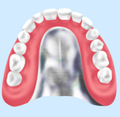 金属床義歯