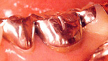 銀歯は金属アレルギーを引き起こす可能性があります