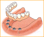 インプラントオーバーデンチャー