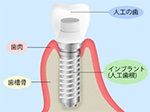 歯を失ってもインプラントがあります