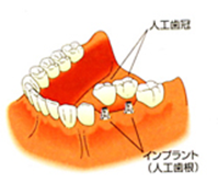 インプラント