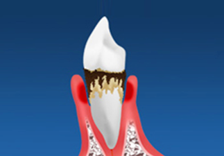 歯を失う原因第1位は歯周病です！